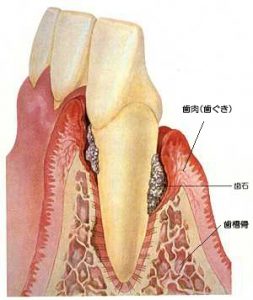 歯周病治療