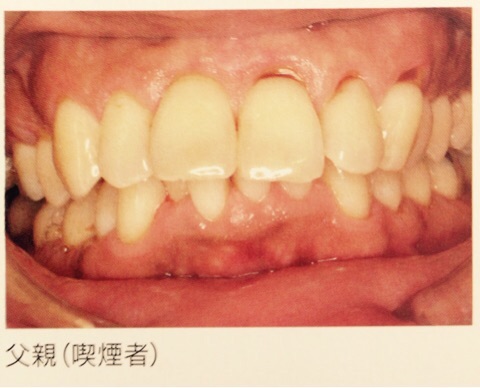 喫煙とお口の健康