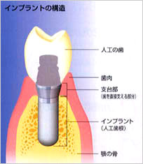 インプラント