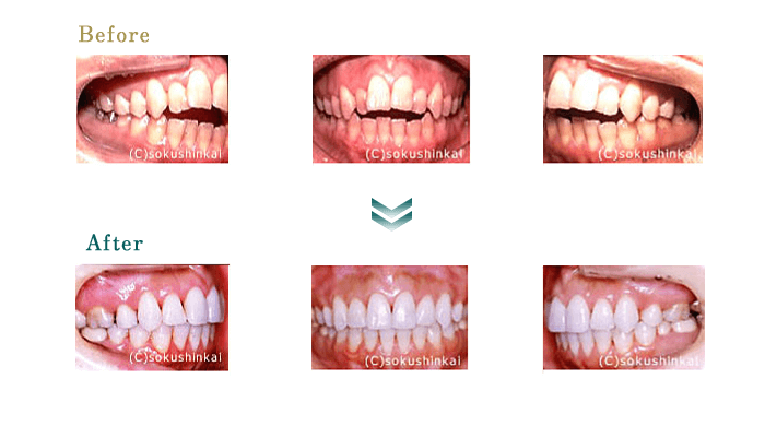 矯正＋ホワイトニング＋オールセラミックス＋メタルボンド　治療
