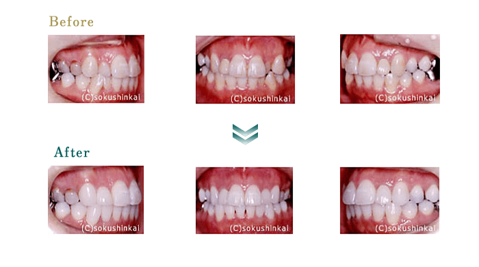 ホワイトニング＋ラミネートベニア　治療