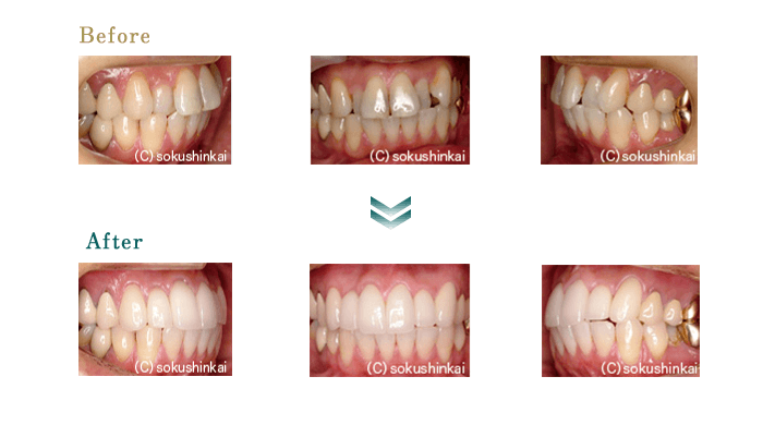 オールセラミックスクラウン＋ホワイトニング　治療