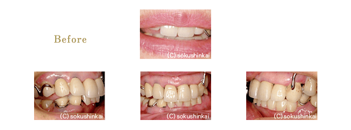 メタルボンドクラウン＋部分義歯　治療前