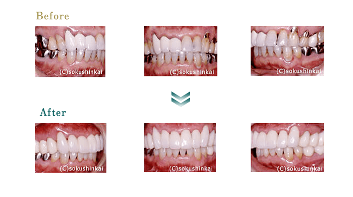 オールセラミックス　治療