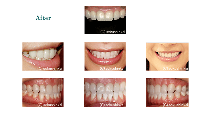 オールセラミックスクラウン＋ラミネートべニア　治療後