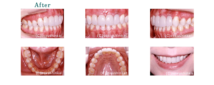 ホワイトニング＋全顎補綴　治療後