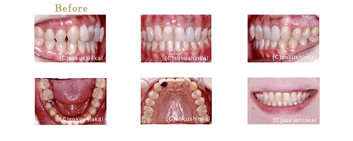 ホワイトニング＋全顎補綴　治療前