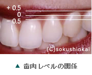 歯肉レベル