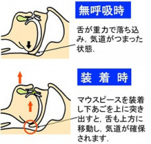 マウスピース