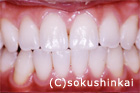 ホワイトニング　症例　施術後