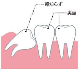 親知らず　大崎シティデンタルクリニック