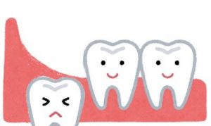 親知らずが埋まっている状態は危険 生え方に合わせた対策を 大崎の歯科 歯医者 大崎シティデンタル 丁寧で痛くない治療
