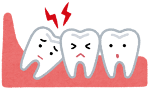 親知らずが埋まっている状態は危険 生え方に合わせた対策を 大崎の歯科 歯医者 大崎シティデンタル 丁寧で痛くない治療