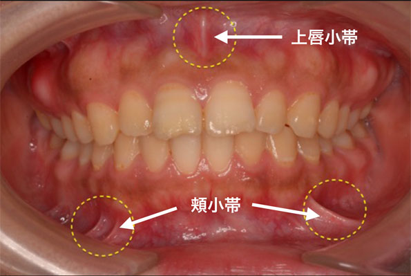 小帯切除術 大崎の歯科・歯医者【大崎シティデンタル】丁寧で痛くない治療