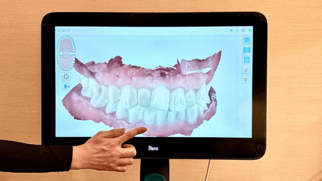 iTeroエレメント5Dプラス