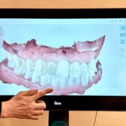 iTeroエレメント5Dプラス