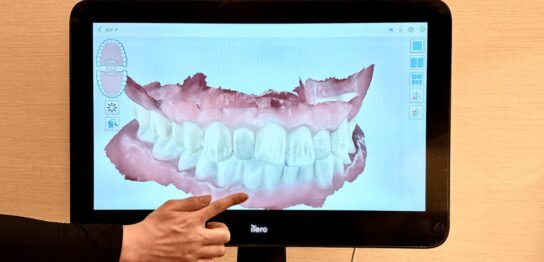 iTeroエレメント5Dプラス